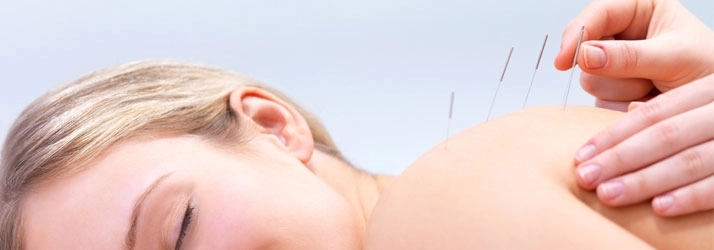 Chiropractic Bellevue WA Acupuncture Acupuncture on a patients back.