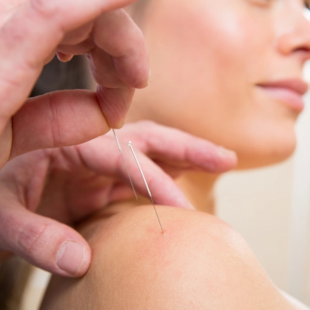 A patient receiving Acupuncture on their shoulder.